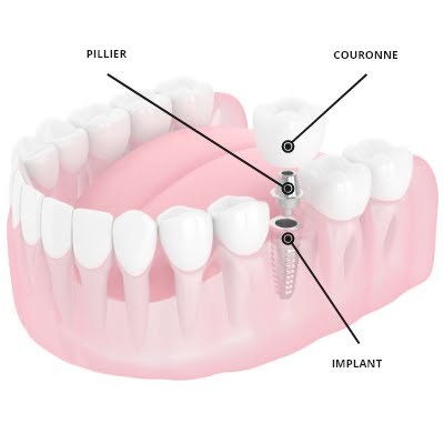 Implant