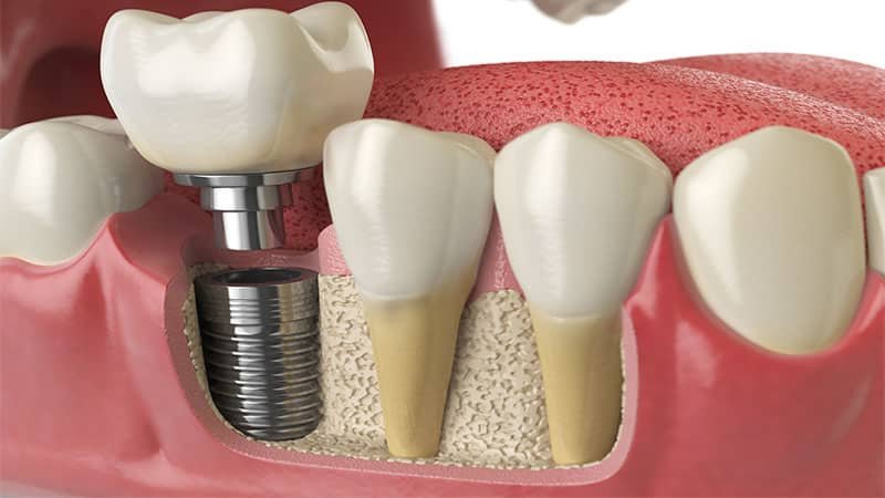 Implant dentaire